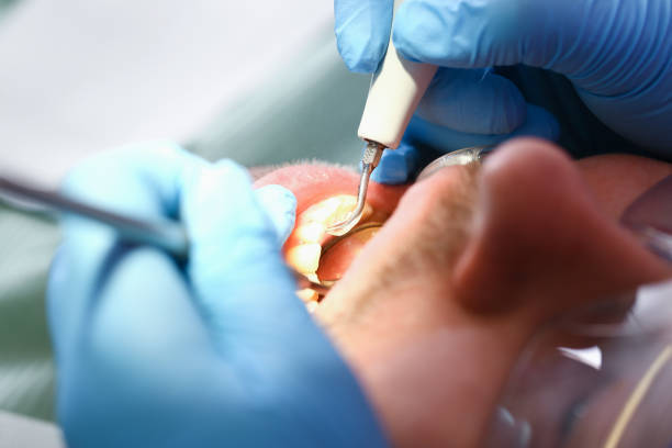 Best Emergency Dentist for Knocked-Out Tooth in Kingsport, TN